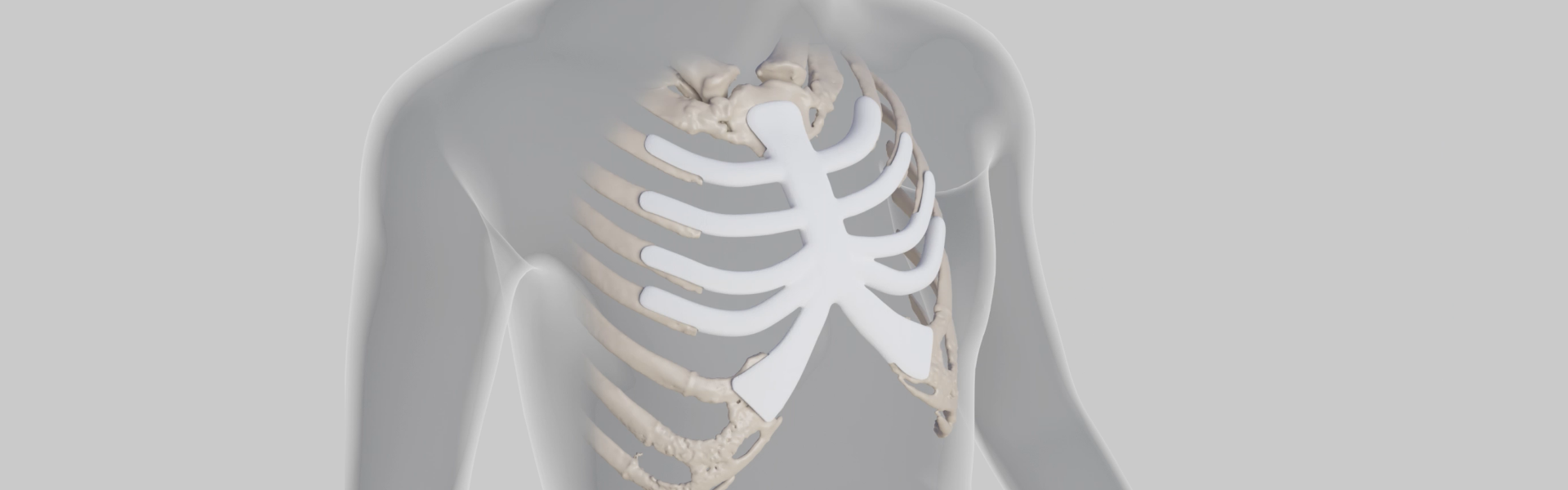 Anatomics StarPore thoracic implant on resected chest