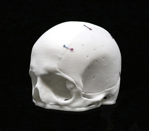 Acrylic Cranial Implant image 1